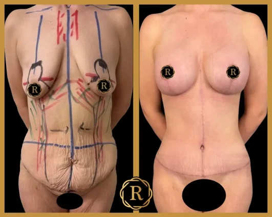 Case_053_BLI_MM_TT_02